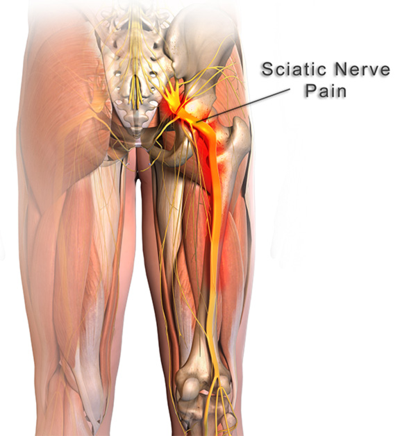 How to sit more comfortably with sciatica (and why you may not